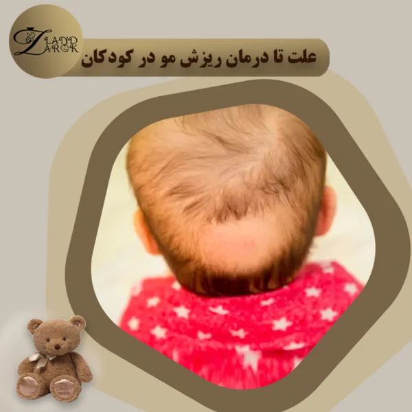 علت و درمان ریزش موی نوزاد
