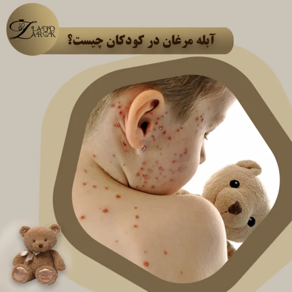 آبله مرغان در کودکان