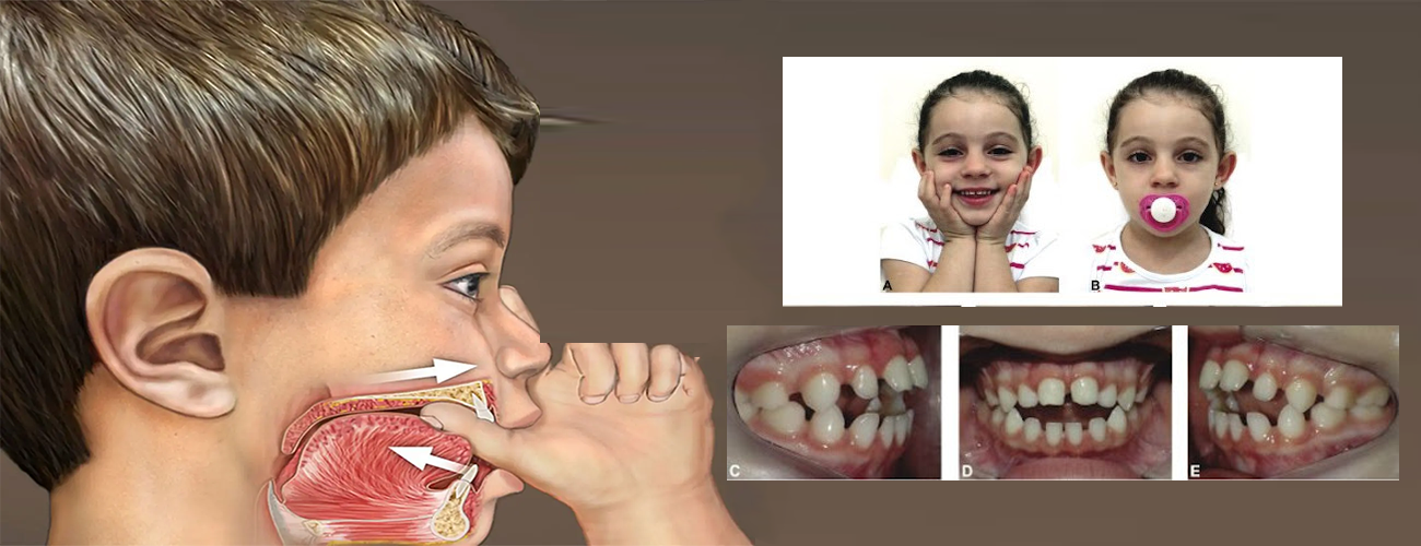 آیا پستانک باعث کج شدن دندان می شود؟