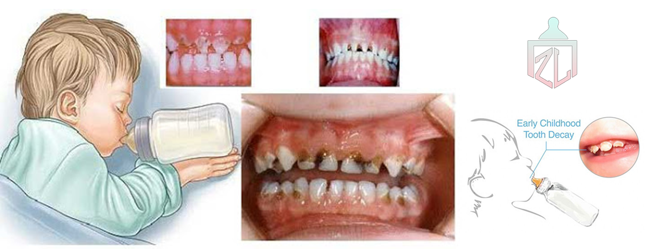 چرا شیر شب باعث پوسیدگی دندان می شود؟