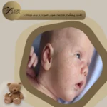 علت جوش زدن صورت نوزاد