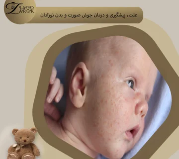 علت جوش زدن صورت نوزاد